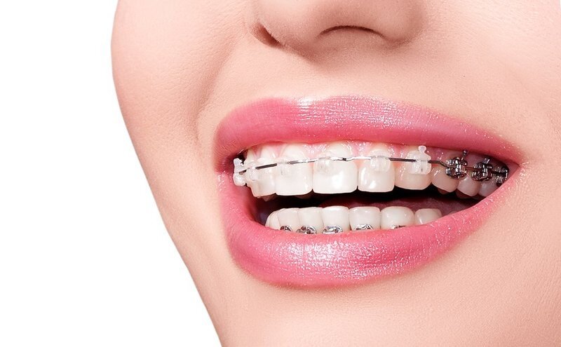 Chia sẻ những kiến thức về niềng răng giúp khắc phục những khuyết điểm của hàm răng như hô, khấp khểnh, .... picture